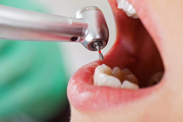 Best Knocked-Out Tooth (Avulsed Tooth) Treatment in Conway Springs, KS